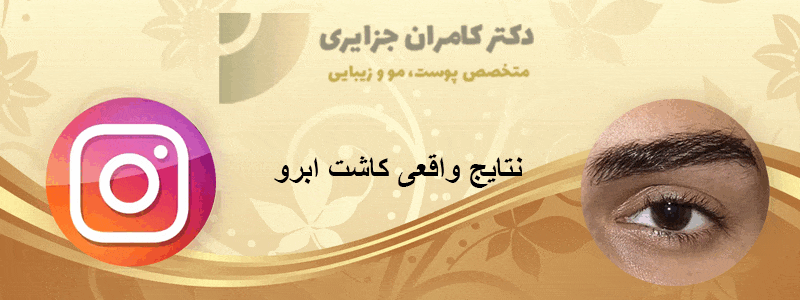نمونه کارهای کاشت ابرو اینستاگرام دکتر جزایری