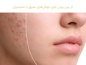 از بین بردن جای جوش‌های عمیق با سابسیژن