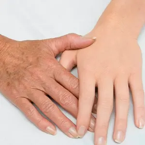 جوانسازی دست توسط بهترین متخصص پوست و مو