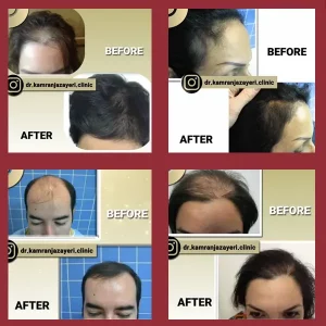 نمونه درمان های کاشت مو آقایان و خانم ها
