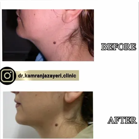 لاغری گردن-نمونهکاردکترجزایری