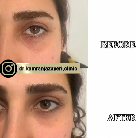 نمونهکار تزریق فیلر زیر چشم