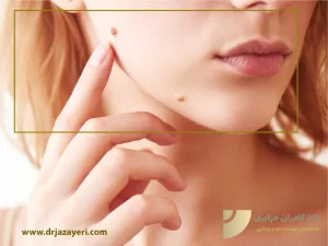 برداشتن خال صورت