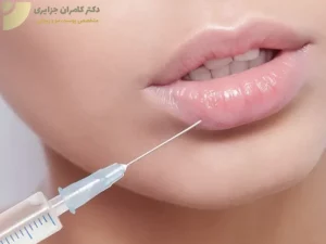تزریق فلیر لب