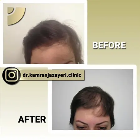 نمونه کاشت موی خانم ها2