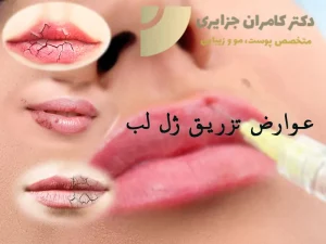 عوارض تزریق ژل لب