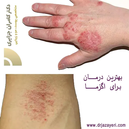انواع روش های درمانی اگزما