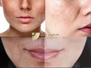 از بین بردن لکه های پوستی با مزوتراپی
