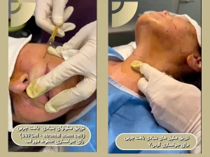 تزریق چربی نانوفت