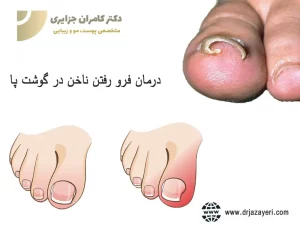 درمان فرو رفتن ناخن در گوشت پا