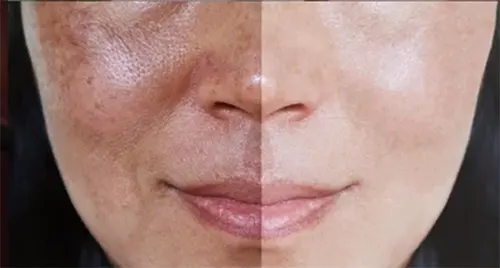 مزوتراپی صورت