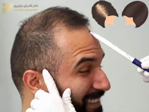 کاشت مو از فردی به فرد دیگر