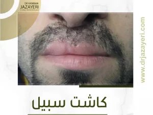 کاشت سیبیل