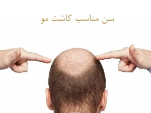 سن مناسب کاشت مو