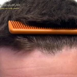کوتاه کردن مو بعد از کاشت مو