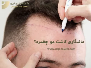 ماندگاری کاشت مو