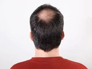 بانک مو برای کاشت و پیوند