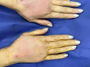 عوارض تزریق چربی