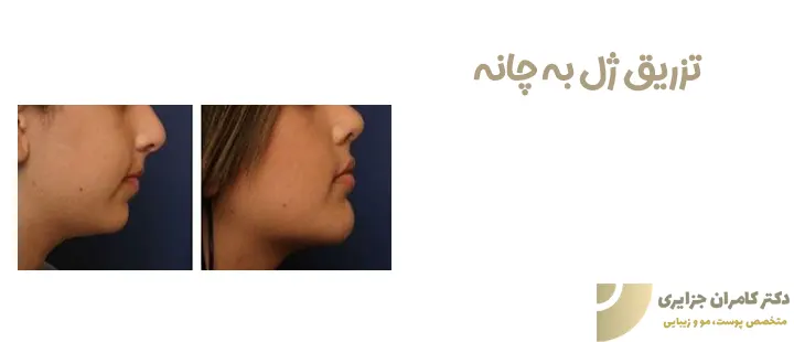 تزریق ژل به چانه
