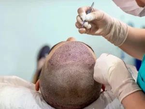مراقبت بعد از کاشت مو