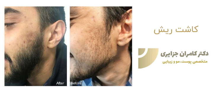 درباره کاشت ریش