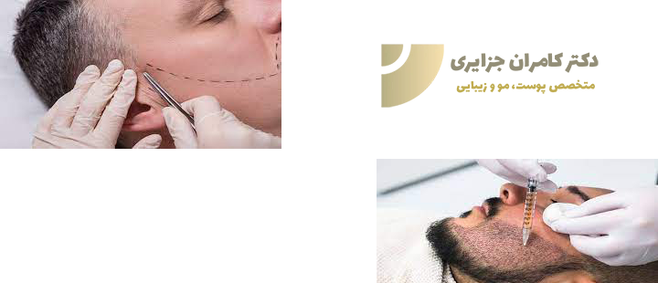 کاشت ریش چیست؟
