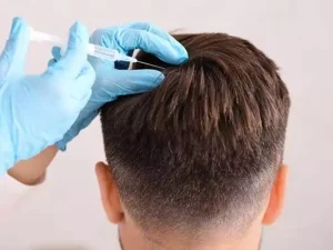 آیا انجام مزوتراپی بعد از کاشت مو ضروری است؟