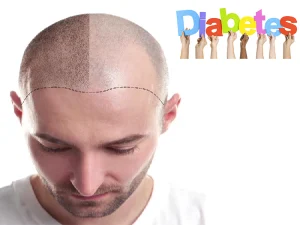 درباره کاشت مو افراد دیابتی