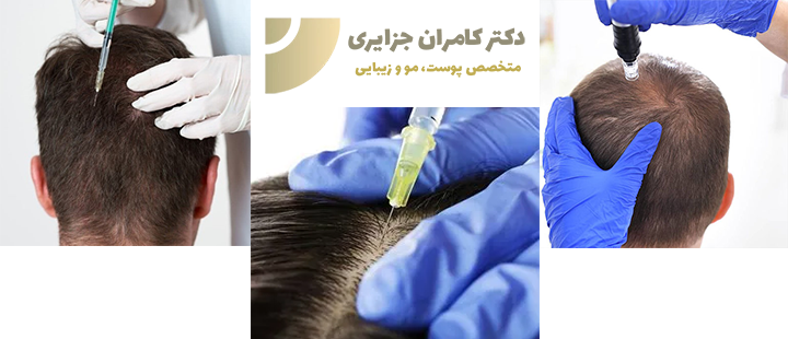مزوتراپی بعد از کاشت مو چگونه است؟