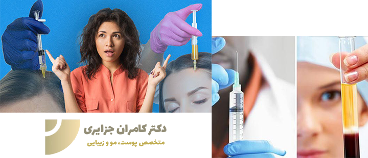 مقایسه پی آر پی و مزوتراپی