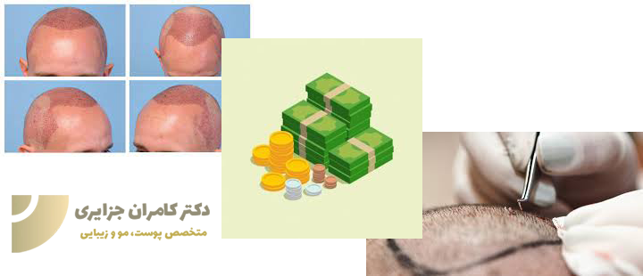 هزینه ی کاشت مو در تهران به چه عواملی بستگی دارد؟