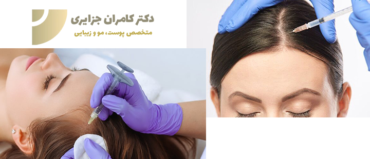 پی آر پی مو چیست؟
