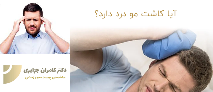 سر درد بعد از کاشت مو