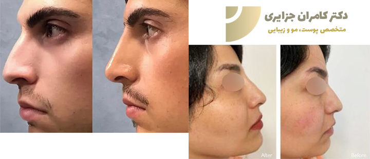 تزریق فیلر بینی چگونه انجام میشود؟