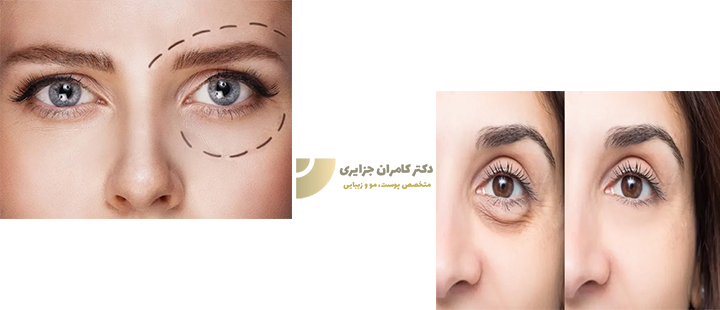 تزریق فیلر زیر چشم