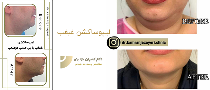 درباره لیپوساکشن غبغب