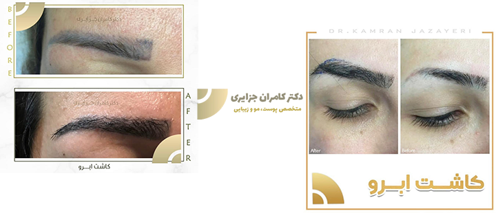 نمونه کار کاشت ابرو دکتر جزایری
