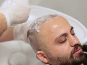 درباره حمام کردن بعد از کاشت مو