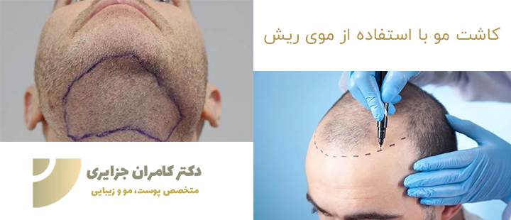 کاشت مو با استفاده از موی ریش امکان پذیر است؟