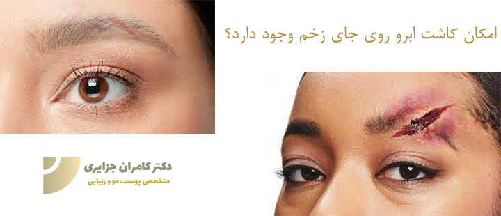 آیا کاشت ابرو روی زخم ممکن است؟