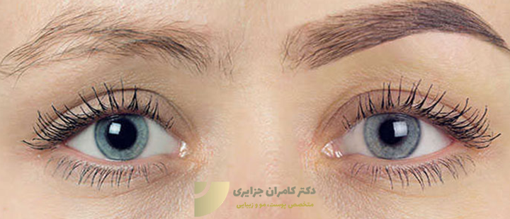 امکان کاشت ابرو روی جای زخم وجود دارد؟