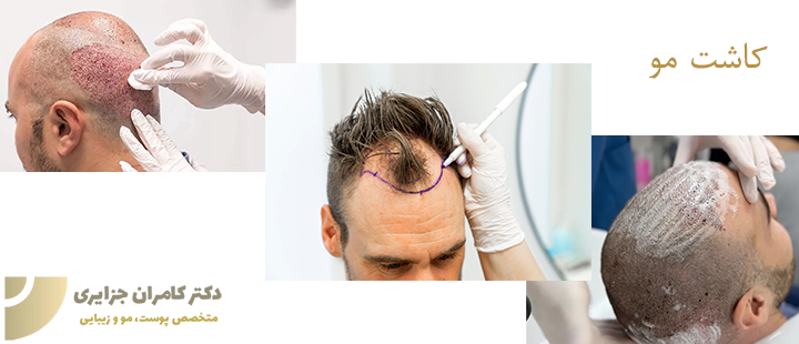 کاشت مو چگونه انجام میشود؟