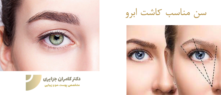 سن مناسب کاشت ابرو