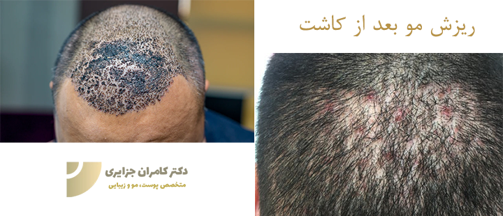 درباره ریزش مو بعد از کاشت