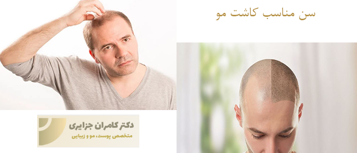 درباره بهترین سن کاشت مو