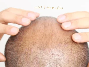 ریزش مو بعد از کاشت