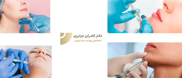 تزریق فیلر چانه چگونه انجام میشود؟