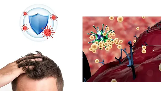 تاثیر بیماری خود ایمنی بر کاشت مو