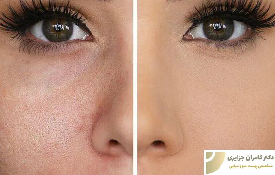 درمان قطعی پوست پرتقالی