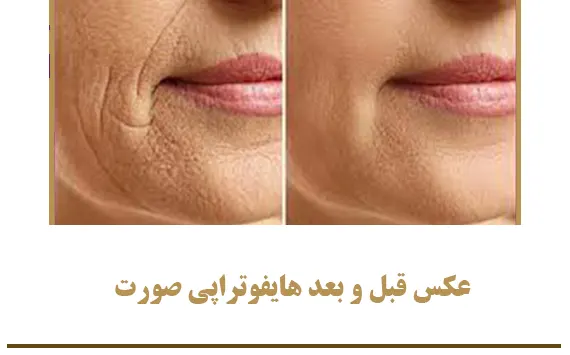 عکس قبل و بعد هایفوتراپی صورت